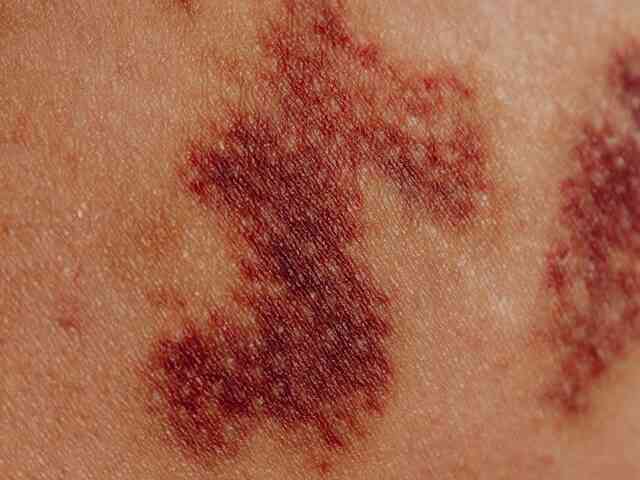 swelling and bruising after rhinoplasty